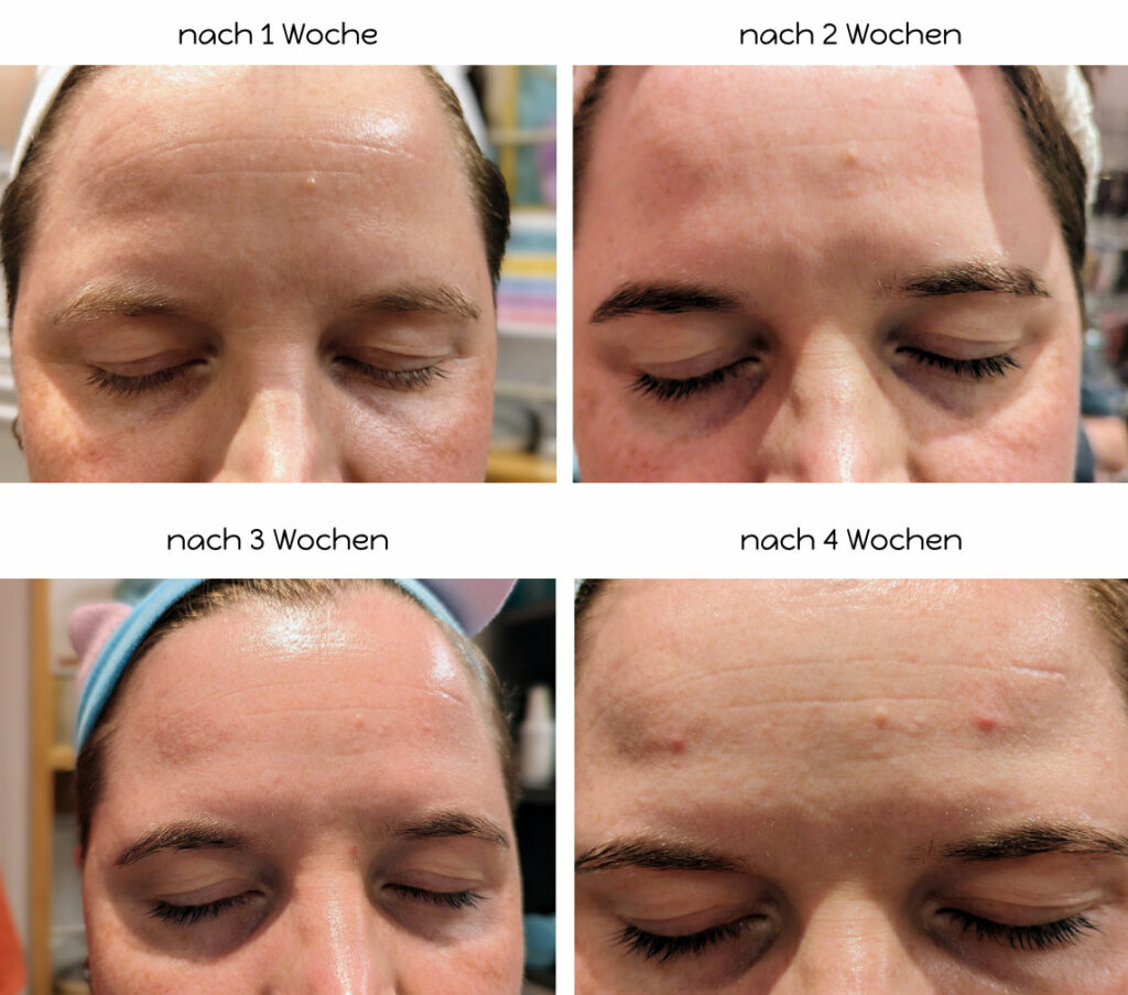 LED Lichttherapie-Maske von Koanna - Ergebnisse Stirn, Nasenansatz